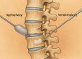 Kyphoplasty and vertebroplasty procedures treating spinal compression fractures in the spine
